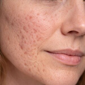 UTSUKUSY C-RETINAL-BŐRMEGÚJÍTÓ ÉS TEXTÚRAJAVÍTÓ A-VITAMIN PROTOKOLL