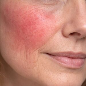 UTSUKUSY RESET SKIN BŐRNYUGTATÚ ÉS REGENERÁLÓ PROTOKOLL