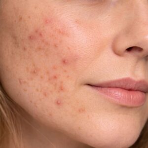 UTSUKUSY TRANEX WHITE-CÉLZOTT PIGMENT KORREKCIÓ